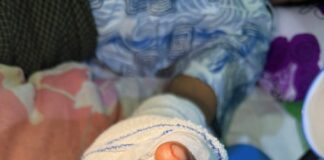 손가락 절단 환자, 본인 발가락 이식 수술 성공…