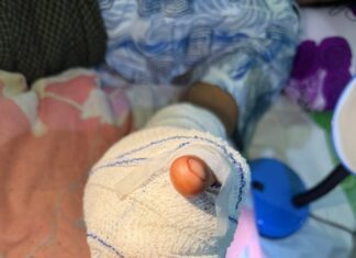 손가락 절단 환자, 본인 발가락 이식 수술 성공…